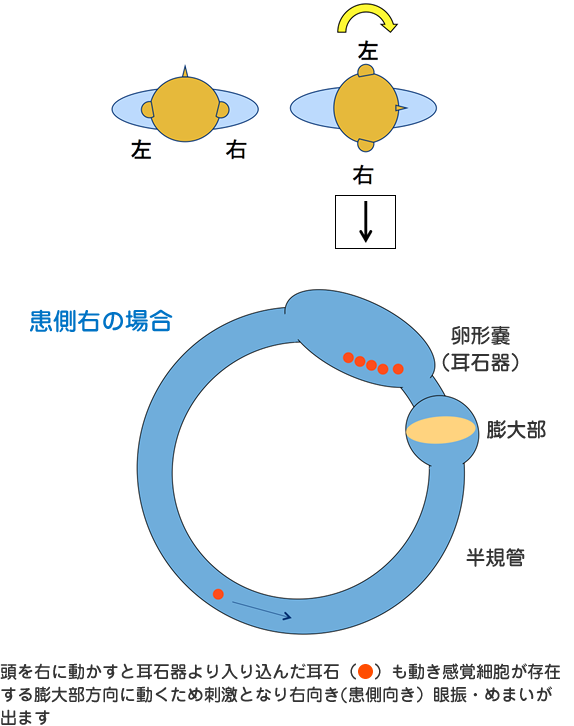 方 めまい 耳 石 治し 耳石がめまいの原因に！どうやって治せばいいの？