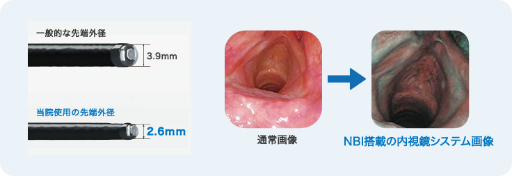 極細径で見るNBI搭載の内視鏡システム画像