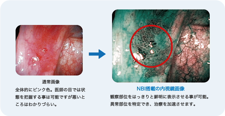 通常画像：全体的にピンク色。医師の目では状態を把握する事は可能ですが悪いところはわかりづらい。　NBI搭載の内視鏡画像：観察部位をはっきりと鮮明に表示させる事が可能。異常部位を特定でき、治療を加速させます。